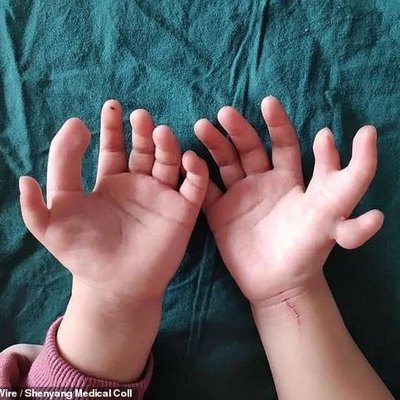 В Китае прооперировали девочку, которая родилась с 14-ю пальцами